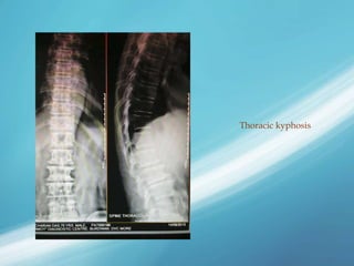 Thoracic kyphosis
 