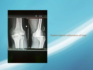 Postero-lateral subluxation of knee
 