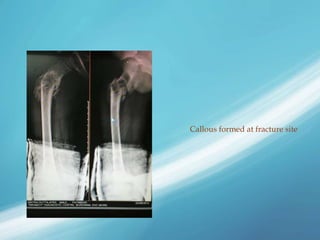 Callous formed at fracture site
 