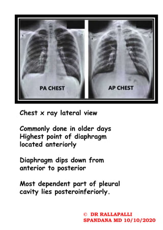 Chest x ray lateral view
Commonly done in older days
Highest point of diaphragm
located anteriorly
Diaphragm dips down from
anterior to posterior
Most dependent part of pleural
cavity lies posteroinferiorly.
© DR RALLAPALLI
SPANDANA MD 10/10/2020
 