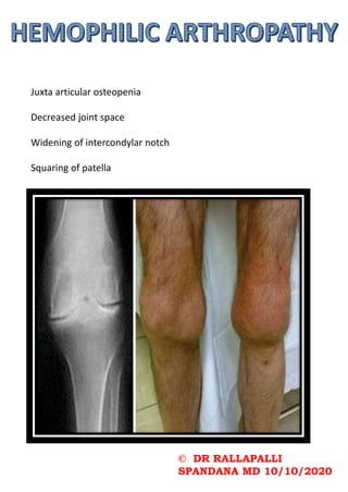 © DR RALLAPALLI
SPANDANA MD 10/10/2020
Juxta articular osteopenia
Decreased joint space
Widening of intercondylar notch
Squaring of patella
 