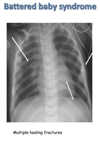 Multiple healing fractures
 