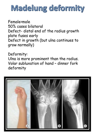 Female>male
50% cases bilateral
Defect- distal end of the radius growth
plate fuses early
Defect in growth (but ulna continues to
grow normally)
Deformity:
Ulna is more prominent than the radius.
Volar subluxation of hand – dinner fork
deformity
 