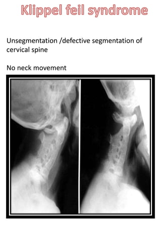 Unsegmentation /defective segmentation of
cervical spine
No neck movement
 