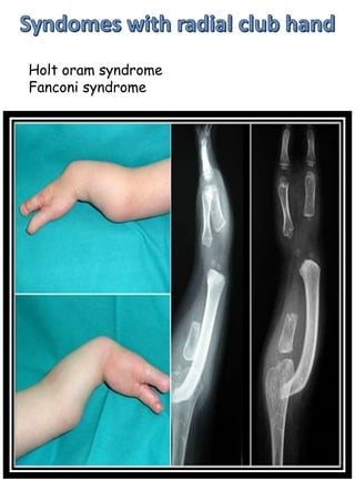 Holt oram syndrome
Fanconi syndrome
 