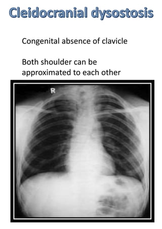Congenital absence of clavicle
Both shoulder can be
approximated to each other
 