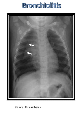 Sail sign – thymus shadow
 
