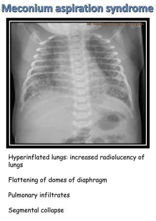 Hyperinflated lungs: increased radiolucency of
lungs
Flattening of domes of diaphragm
Pulmonary infiltrates
Segmental collapse
 