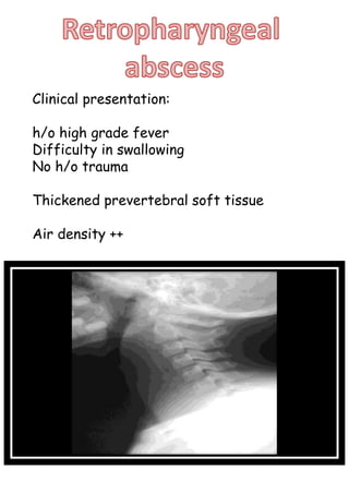 Clinical presentation:
h/o high grade fever
Difficulty in swallowing
No h/o trauma
Thickened prevertebral soft tissue
Air density ++
 