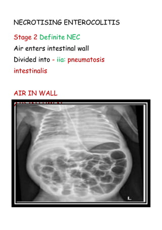 NECROTISING ENTEROCOLITIS
Stage 2 Definite NEC
Air enters intestinal wall
Divided into - iia: pneumatosis
intestinalis
AIR IN WALL
AIR IN LUMEN
 