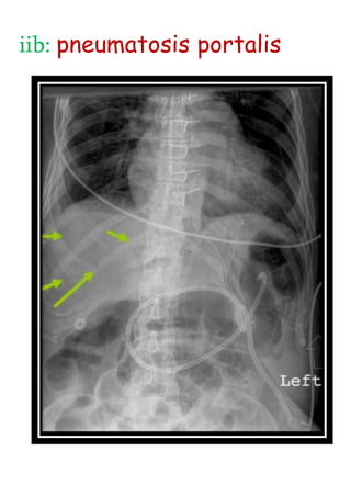 iib: pneumatosis portalis
 