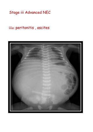 Stage iii Advanced NEC
iiia: peritonitis , ascites
 