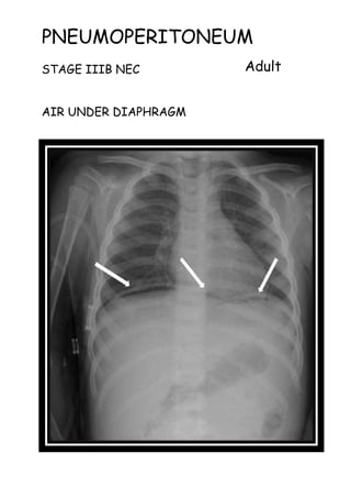 PNEUMOPERITONEUM
STAGE IIIB NEC
AIR UNDER DIAPHRAGM
Adult
 
