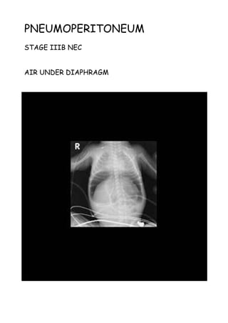 PNEUMOPERITONEUM
STAGE IIIB NEC
AIR UNDER DIAPHRAGM
 
