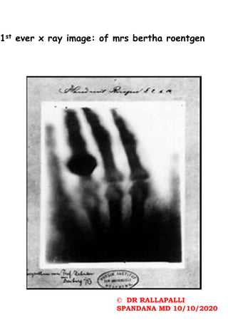1st ever x ray image: of mrs bertha roentgen
© DR RALLAPALLI
SPANDANA MD 10/10/2020
 