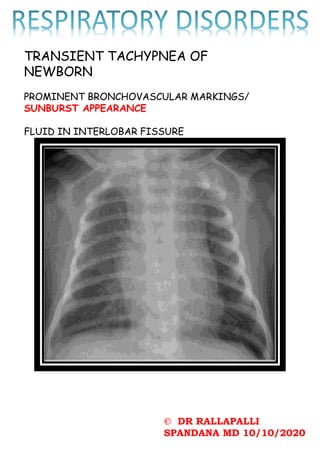© DR RALLAPALLI
SPANDANA MD 10/10/2020
TRANSIENT TACHYPNEA OF
NEWBORN
PROMINENT BRONCHOVASCULAR MARKINGS/
SUNBURST APPEARANCE
FLUID IN INTERLOBAR FISSURE
 