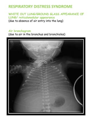 RESPIRATORY DISTRESS SYNDROME
WHITE OUT LUNG/GROUND GLASS APPEARANCE OF
LUNG/ reticulonodular appearance
(due to absence of air entry into the lung)
Air bronchogram
(due to air in the bronchus and bronchioles)
 