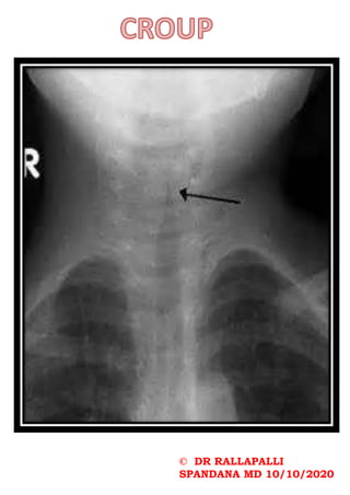 © DR RALLAPALLI
SPANDANA MD 10/10/2020
 