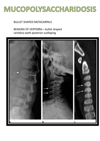 BULLET SHAPED METACARPALS
BEAKING OF VERTEBRA – bullet shaped
vertebra woth posterior scalloping
 