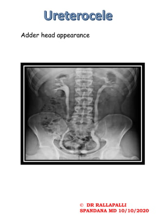 © DR RALLAPALLI
SPANDANA MD 10/10/2020
Adder head appearance
 