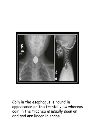 Coin in the esophagus is round in
appearance on the frontal view whereas
coin in the trachea is usually seen on
end and are linear in shape.
 