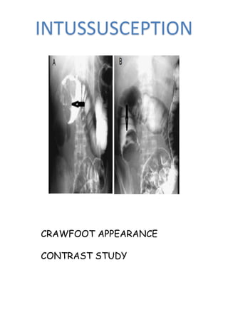 INTUSSUSCEPTION
CRAWFOOT APPEARANCE
CONTRAST STUDY
 