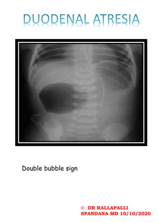 © DR RALLAPALLI
SPANDANA MD 10/10/2020
Double bubble sign
 