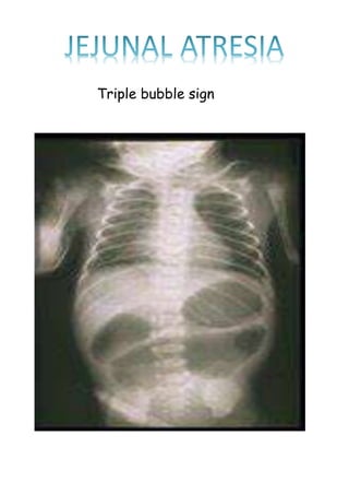 Triple bubble sign
 