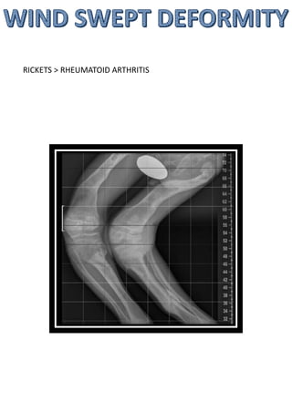 RICKETS > RHEUMATOID ARTHRITIS
 
