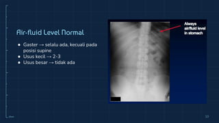 10cm 10
Air-fluid Level Normal
● Gaster → selalu ada, kecuali pada
posisi supine
● Usus kecil → 2-3
● Usus besar → tidak ada
 