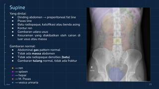 10cm 15
Supine
Yang dinilai:
● Dinding abdomen → preperitoneal fat line
● Psoas line
● Batu radiopaque, kalsiﬁkasi atau benda asing
● Kontur ren
● Gambaran udara usus
● Kesuraman yang diakibatkan oleh cairan di
luar usus atau massa
Gambaran normal:
● Abdominal gas pattern normal
● Tidak ada massa abdomen
● Tidak ada radiopaque densities (batu)
● Gambaran tulang normal, tidak ada fraktur
● → ren
● → spleen
● → hepar
● → M. Psoas
● → vesica urinaria
 