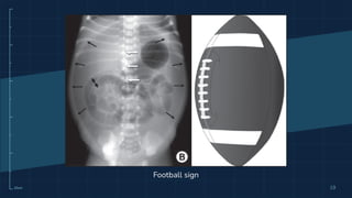 X-Ray Abdomen Lena.pdf