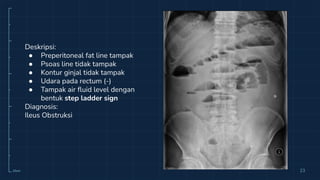 10cm 23
Deskripsi:
● Preperitoneal fat line tampak
● Psoas line tidak tampak
● Kontur ginjal tidak tampak
● Udara pada rectum (-)
● Tampak air ﬂuid level dengan
bentuk step ladder sign
Diagnosis:
Ileus Obstruksi
 