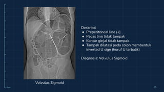 10cm 25
Volvulus Sigmoid
Deskripsi
● Preperitoneal line (+)
● Psoas line tidak tampak
● Kontur ginjal tidak tampak
● Tampak dilatasi pada colon membentuk
inverted U sign (huruf U terbalik)
Diagnosis: Volvulus Sigmoid
 