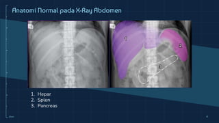10cm 4
1. Hepar
2. Splen
3. Pancreas
Anatomi Normal pada X-Ray Abdomen
 
