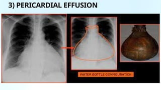 X-Ray BASICS ABDOMEN & CHEST OVERALL BASICS.pptx