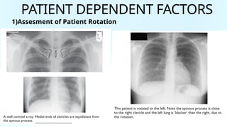 Patient Rotation Cxr Example X-Ray BASICS ABDOMEN & CHEST OVERALL BASICS.pptx