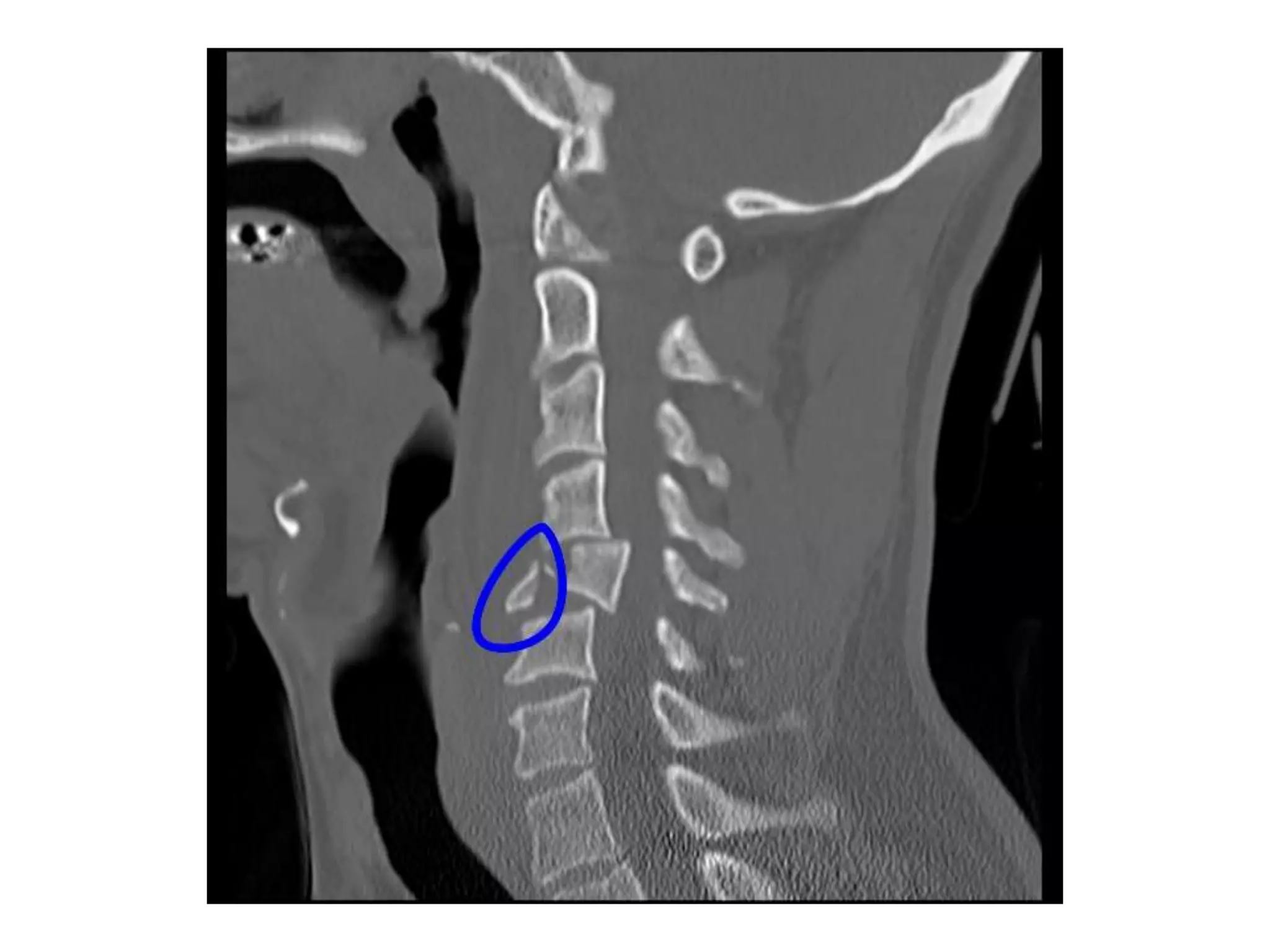 X ray c-spine | PPTX