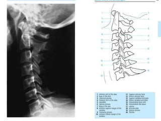 Cd Spine Example X ray c-spine | PPTX
