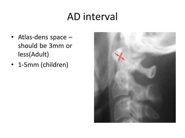 Cd Spine Example X ray c-spine | PPTX