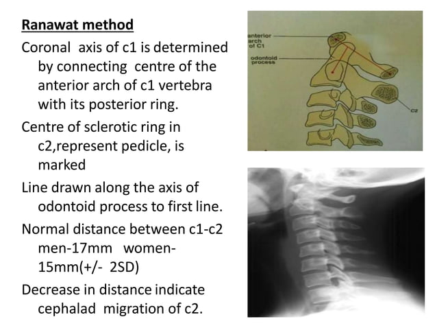 Cd Spine Example X ray c-spine | PPTX
