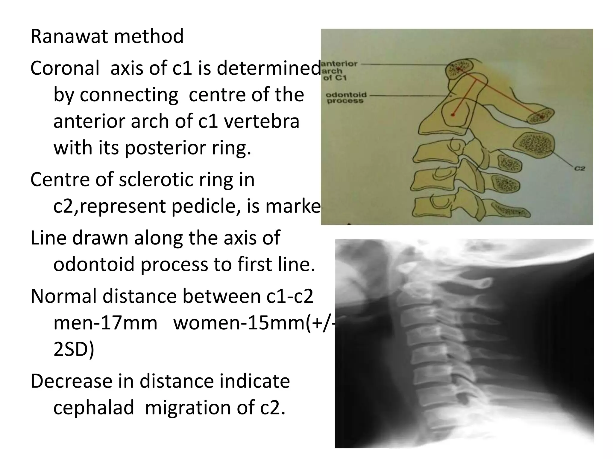 Coronal Process On Radiograph X ray c-spine | PPTX