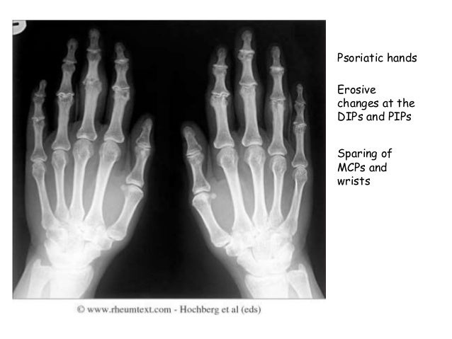 X ray changes in different types of arthritis X ray changes in different types of arthritis