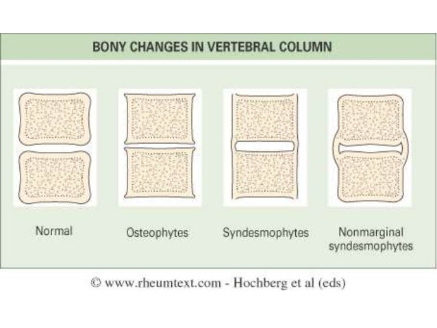 x-ray-changes-in-different-types-of-arthritis