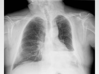 X-ray chest in surgery.pptx