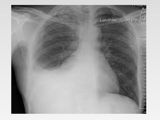 X-ray chest in surgery.pptx