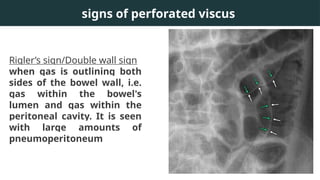 X-Ray & CT in Acute Abdomen-Radiology.pptx