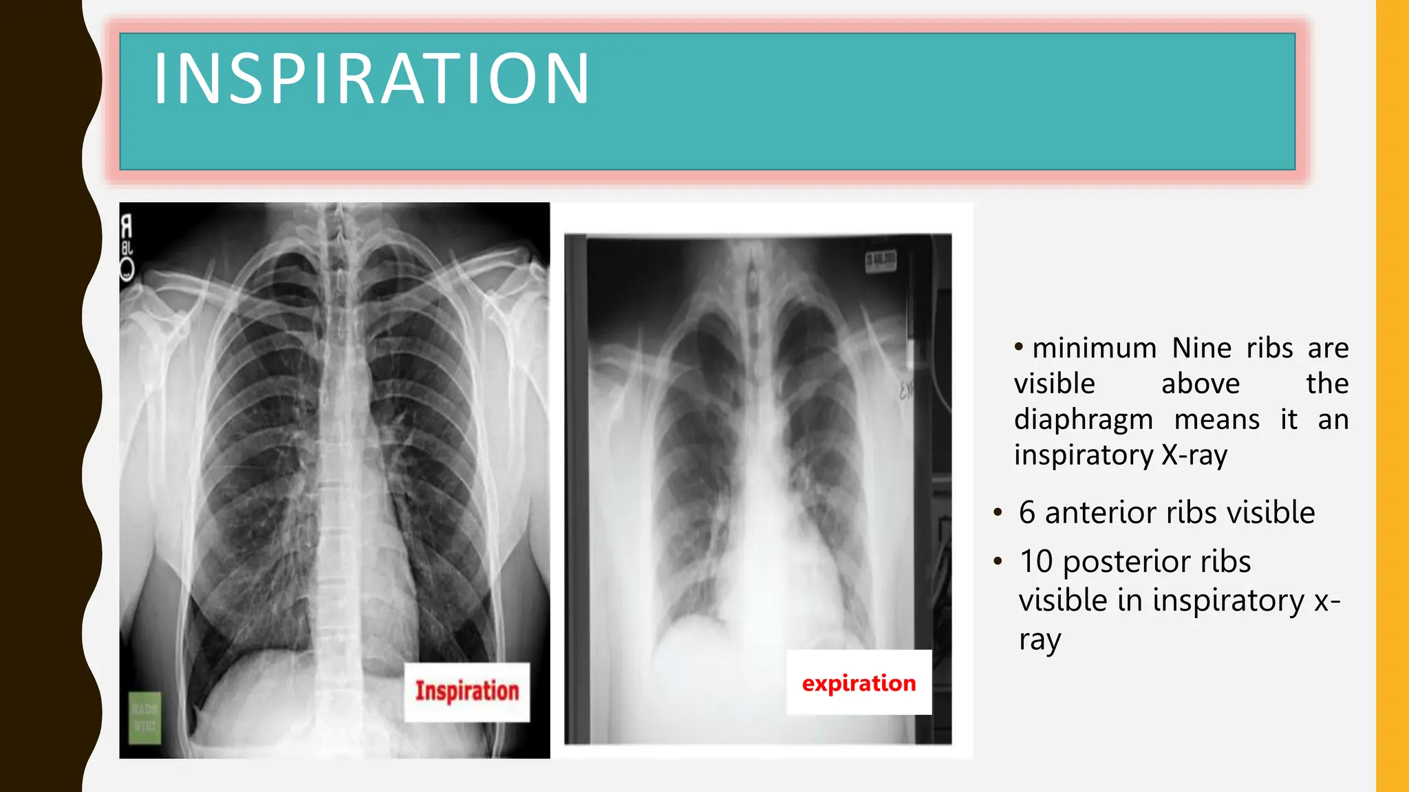 Inspiration Normal Ribs x-ray ppt made bye Dr nishant this is the best pdf to understand x ray ...