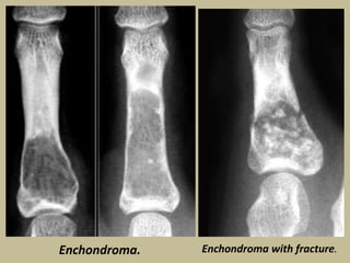 X Ray Film Reading For Bone Tumour PPTX