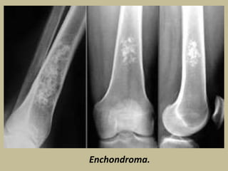 X Ray Film Reading For Bone Tumour PPTX
